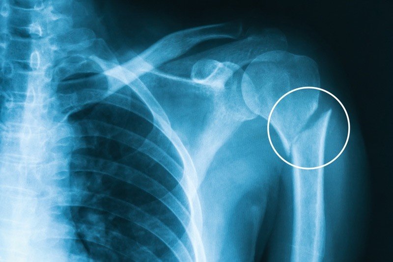 Best Bone Fracture doctors in Sector 55 Gurugram