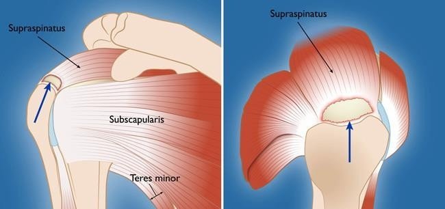 Best Rotator Cuff Repair Surgeon in Gurugram