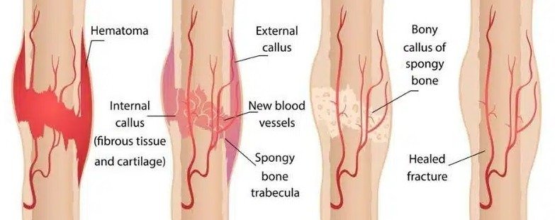 Best Faster Bone Healing in Gurugram Sector 51