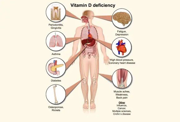 Best Vitamin D Deficiency Treatment in DLF Phase