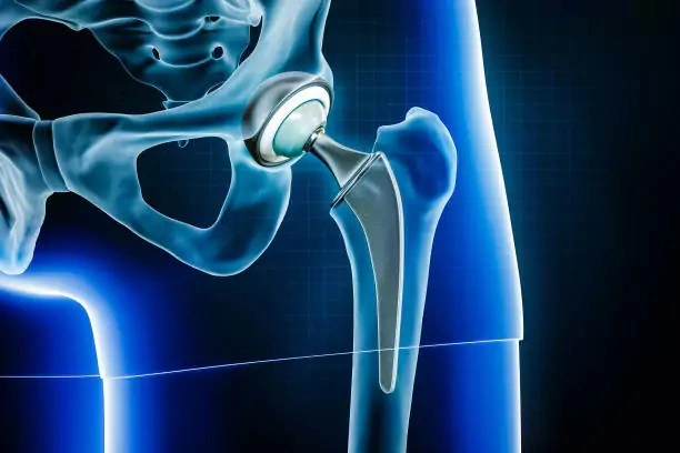 Best Hospital for Hip Replacement in Gurugram Sector 52