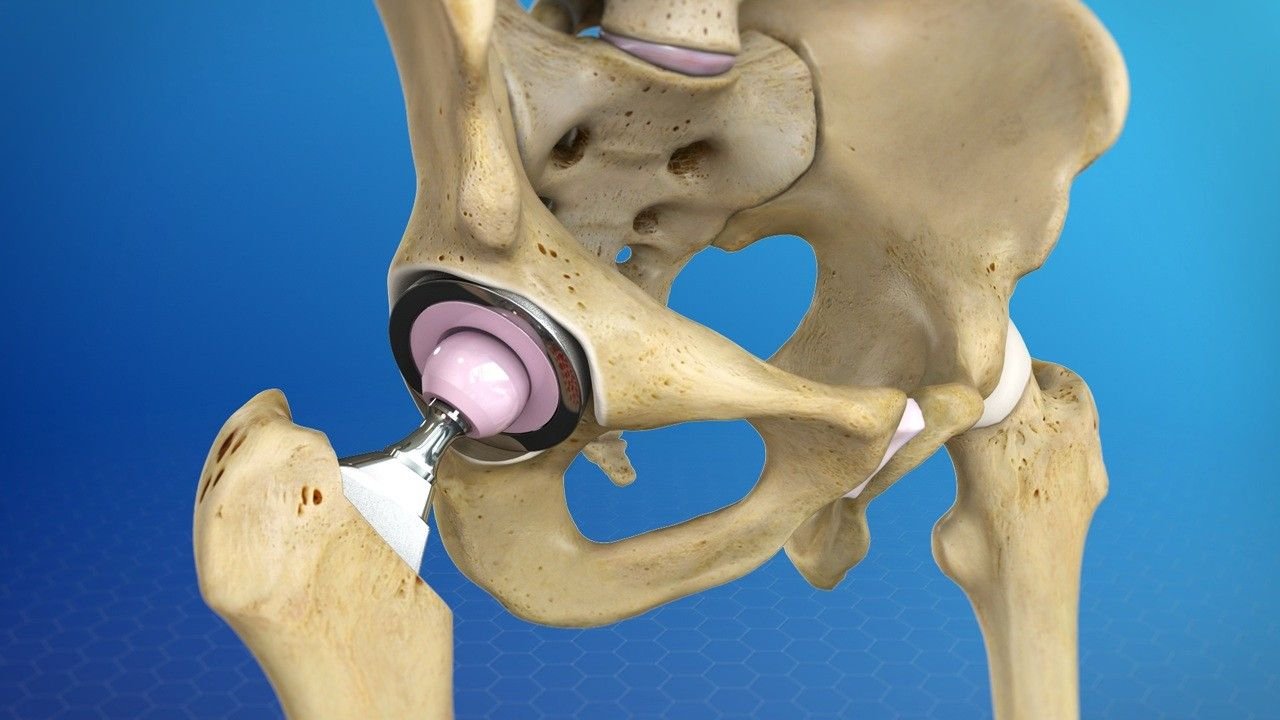 Best Hip Replacement Doctor in Gurugram