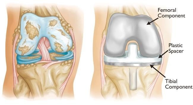 Best Knee Replacement Surgery in Gurugram