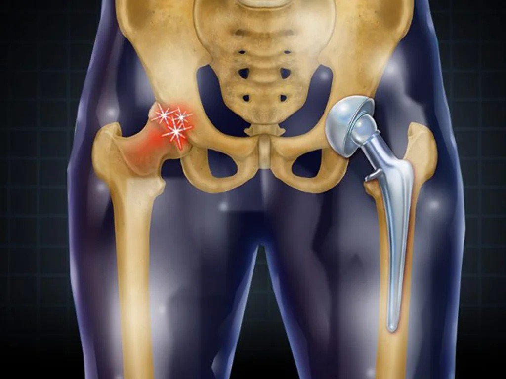 Best Hip Replacement Surgeon in Gurugram