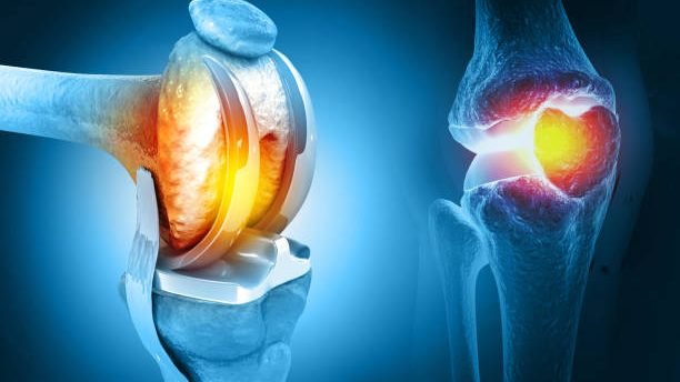 Human knee replacement surgery. Knee joint treatment. Knee injury. 3d illustration
